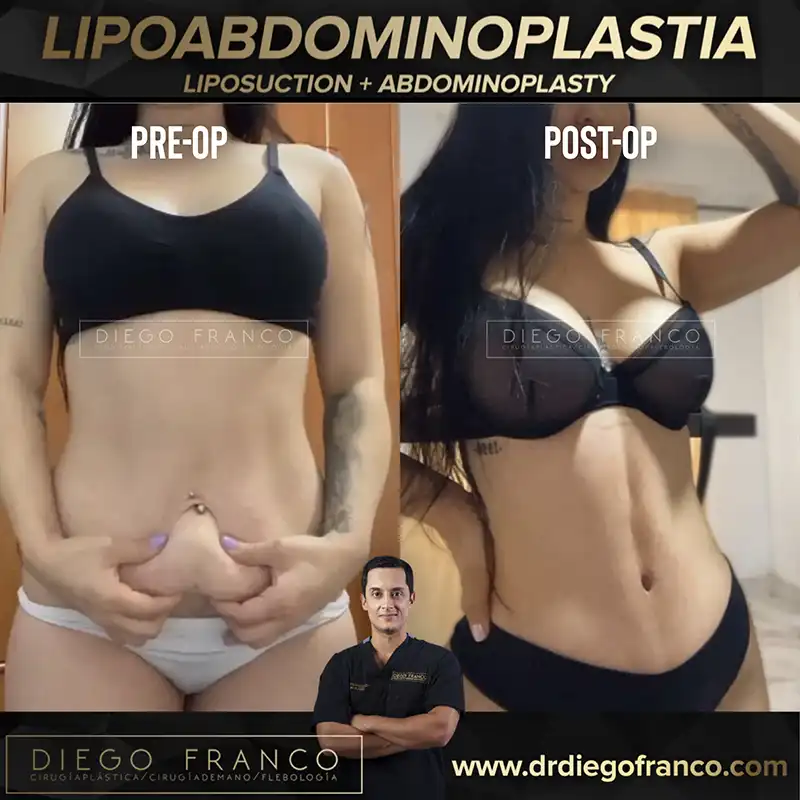 img-abdominoplasty-pereira-1