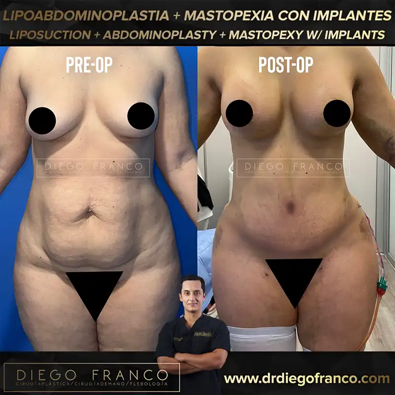 img-mommy-makeover-pereira-1