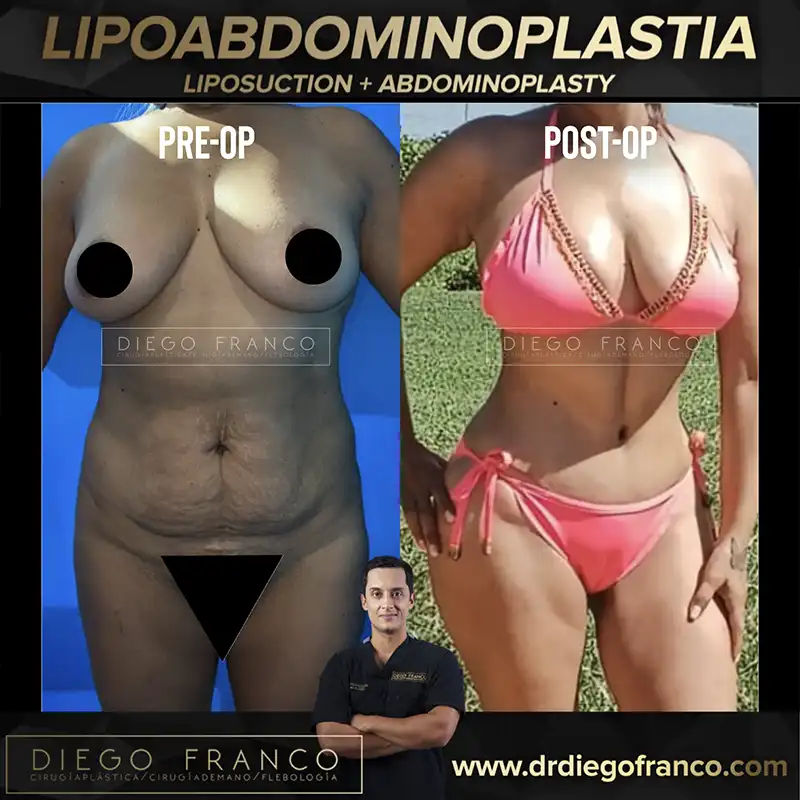 img-abdominoplastia-en-medellin-1