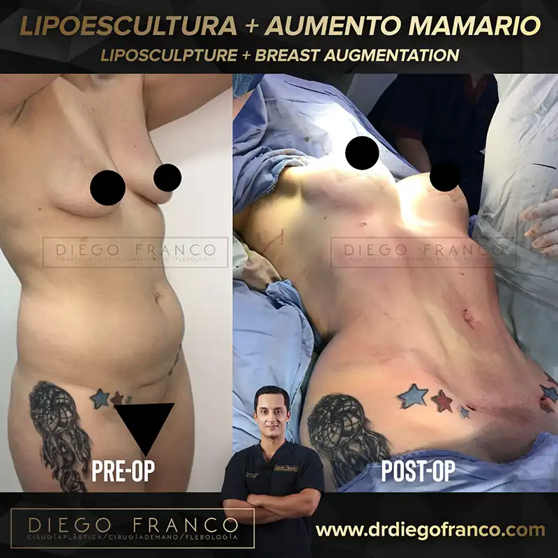 img-mommy-makeover-en-medellin-1