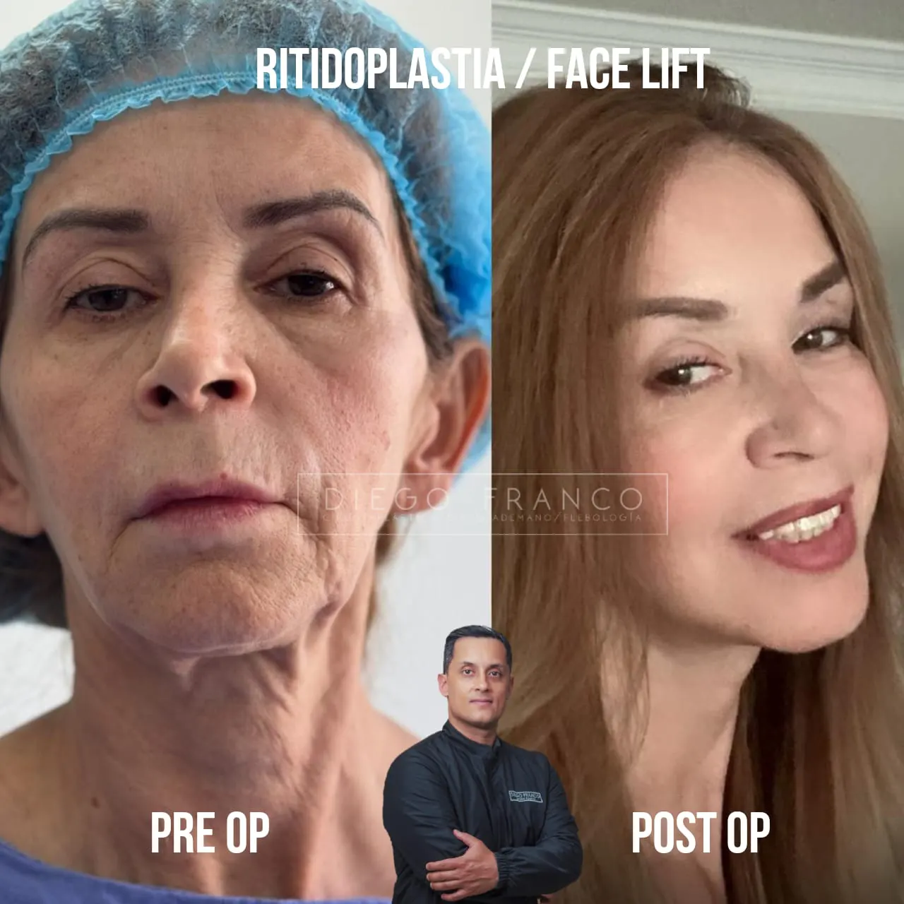 img-rejuvenecimiento-facial-en-medellin-1