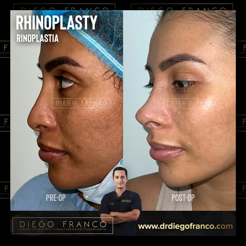 img-rinoplastia-en-pereira-1