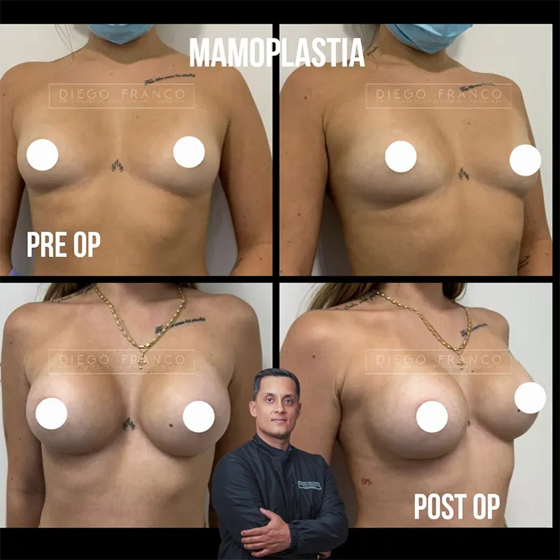 Img-Dr. Diego Franco-Antes&Despues-Mamoplastia-9 Img-Dr. Diego Franco-Antes&Despues-Mamoplastia-9