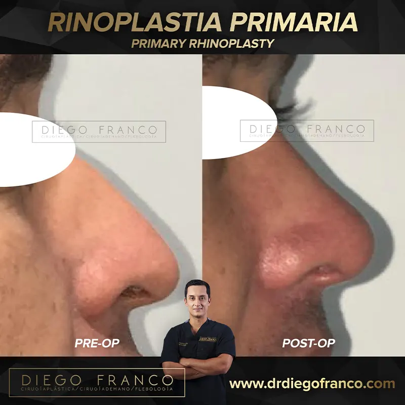 Img-Dr. Diego Franco-Antes&Despues-Rinoplastia-11 Img-Dr. Diego Franco-Antes&Despues-Rinoplastia-11
